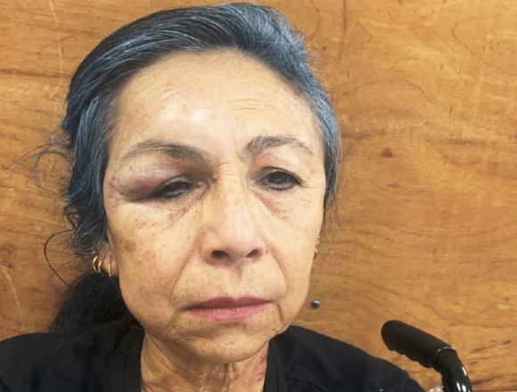 robo Enfermera es brutalmente golpeada durante asalto en Luque